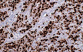 Cervical Cancer: Ki-67 — Anti-Mouse HRP (2)